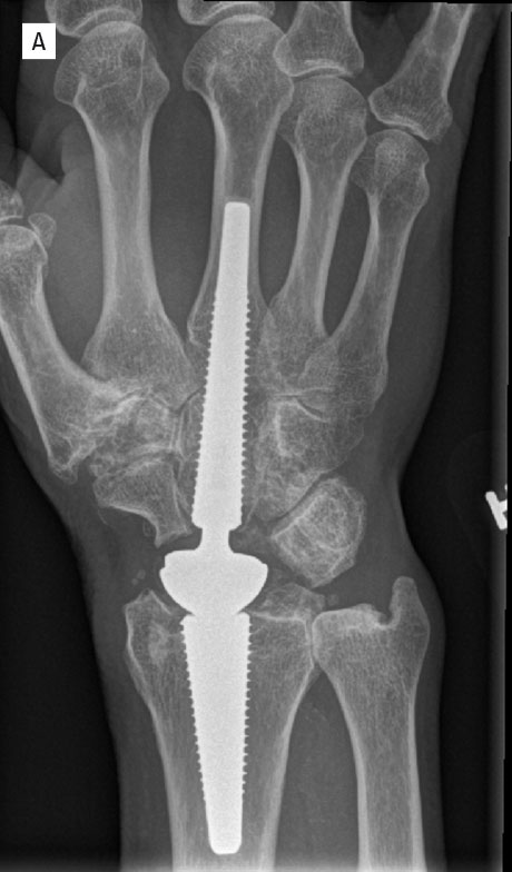 Figur 3. Kontroll etter 4 år. a. Tett ben-implantat kontakt uten tegn til løsning. Pasienten er smertefri, har god bevegelighet i det opererte høyre håndledd (b-e) og god kraft. 